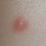 Bouton de moustique