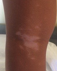 Vitiligo