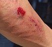 abrasion
