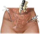 Chirurgie appendicite